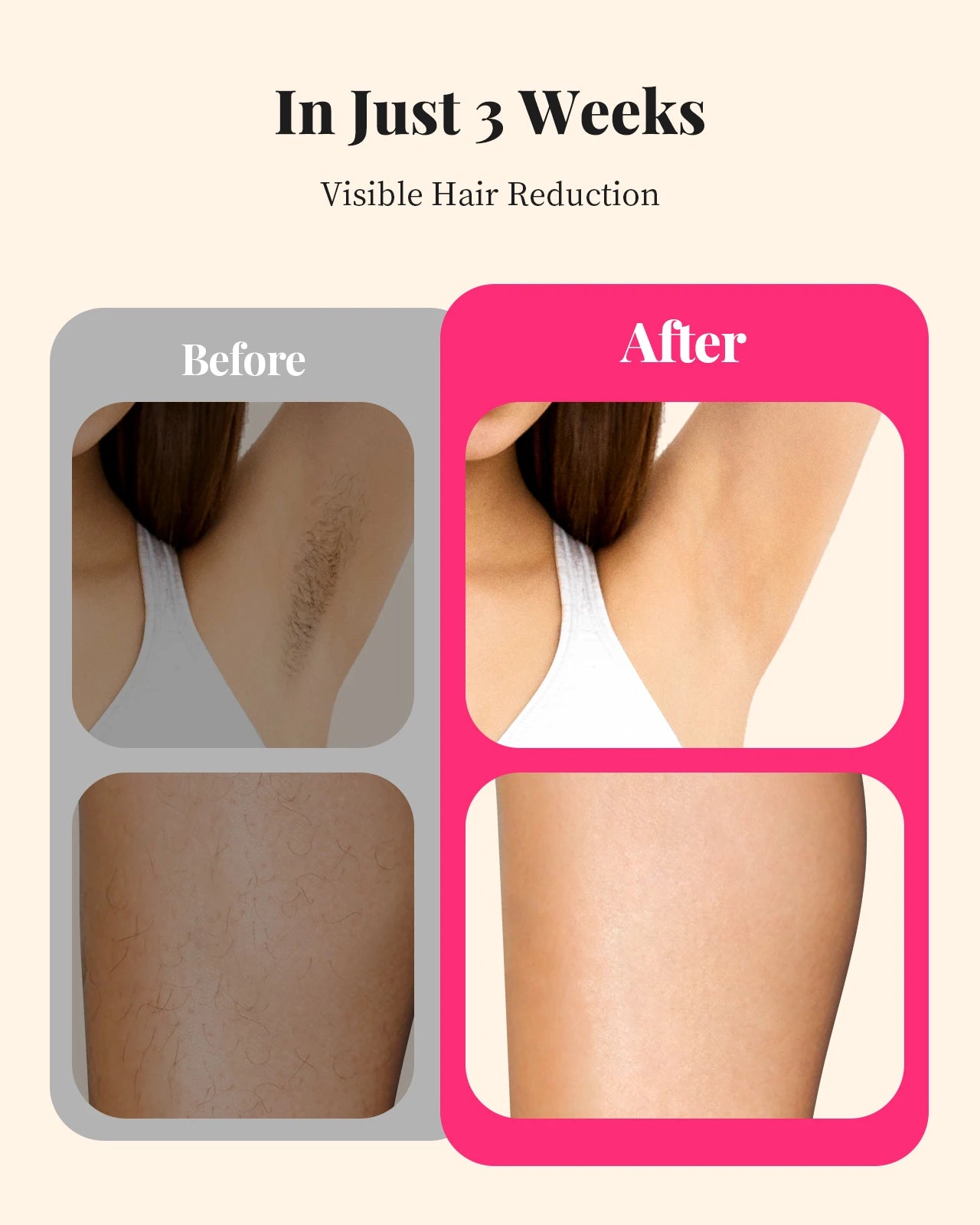 Totmizby IPL Hair Removal For Women And Men Face Body